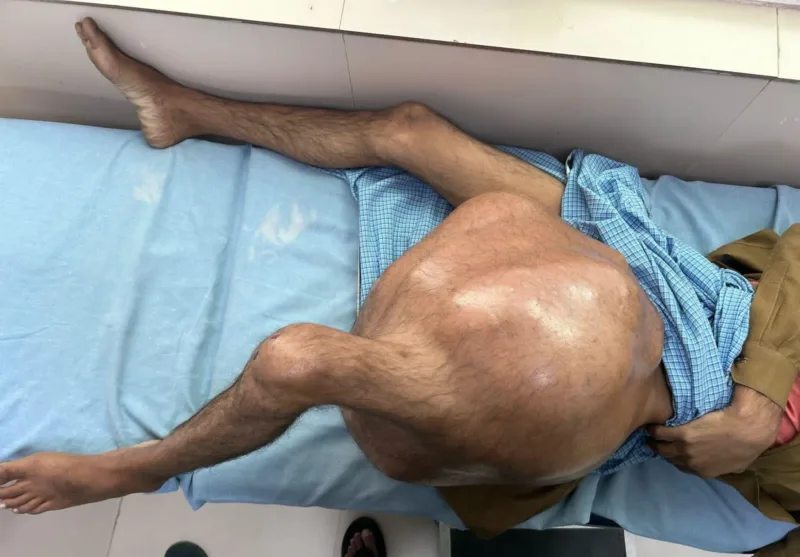 एम्स ऋषिकेश के डॉक्टरों को देश का सबसे बड़ा बोन ट्यूमर निकलने में मिली सफलता, जानिए पूरी खबर