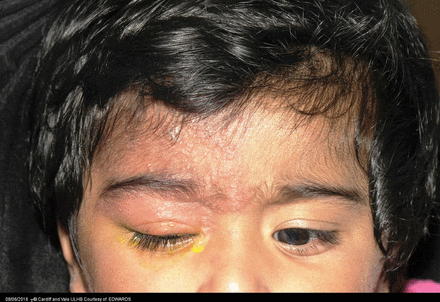 देहरादून में फैल रही है आंखों की ये खतरनाक बीमारी, हल्के में लिया तो जा सकती है रोशनी?